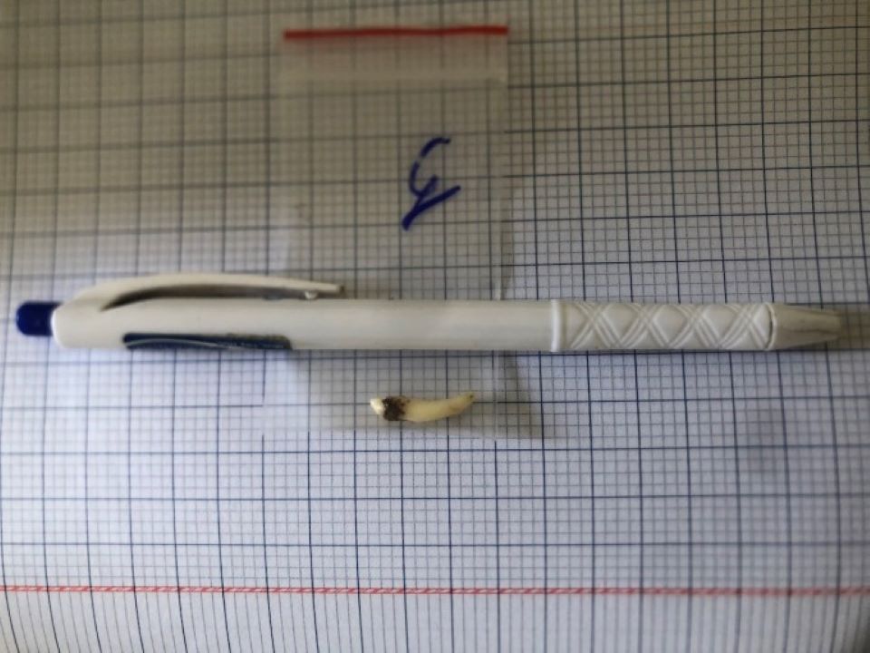 Hiếm có: Răng thừa dài 2cm mọc ngược trong hốc mũi cô gái