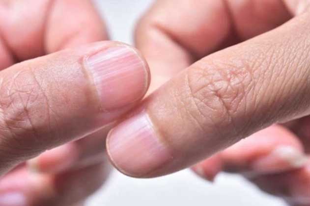 4 biểu hiện trên đôi bàn tay chứng tỏ gan 'nát bấy', có 2 cái thì nên đi khám ngay