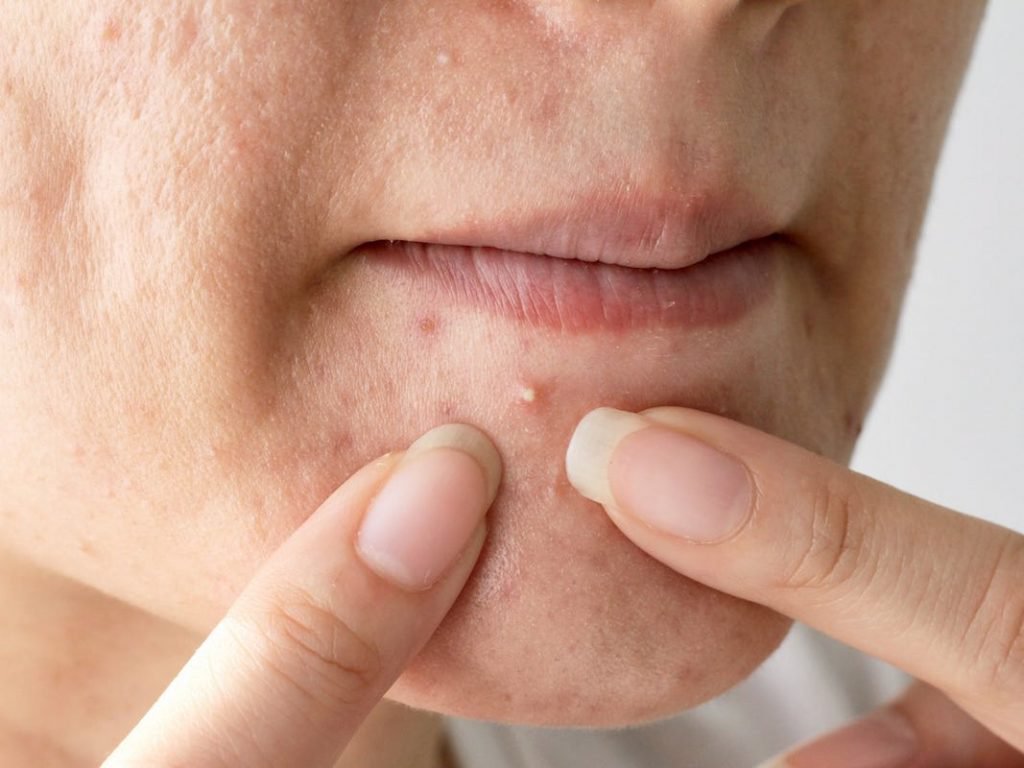 Cách phòng ngừa mụn đầu trắng vô cùng hiệu quả