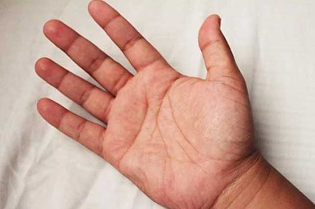 "1 lồi, 2 đỏ, 2 đau'' cảnh báo ung thư gan: Dấu hiệu không thể nhầm, đi khám ngay còn kịp