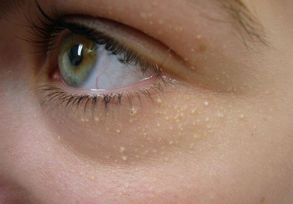 3 công thức trị mụn thịt từ thiên nhiên bạn nên nhớ