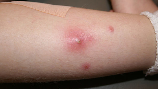 Cách chữa mụn nhọt tại nhà cực đơn giản bạn cần nhớ