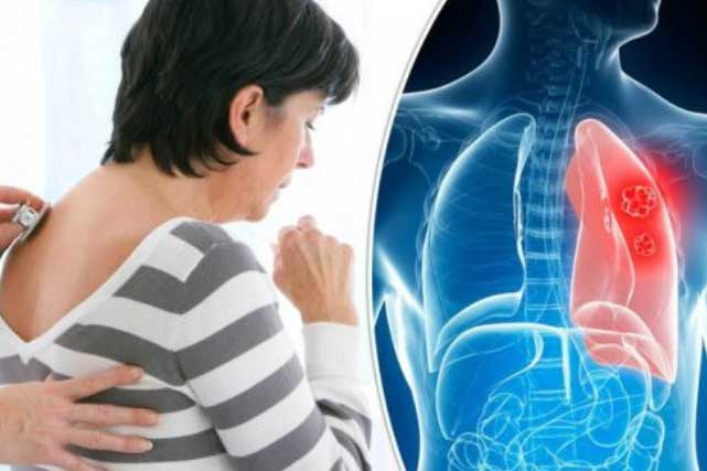 5 dấu hiệu cảnh báo phổi đang bị tấn công, thường bị nhiều người bỏ qua mà không biết