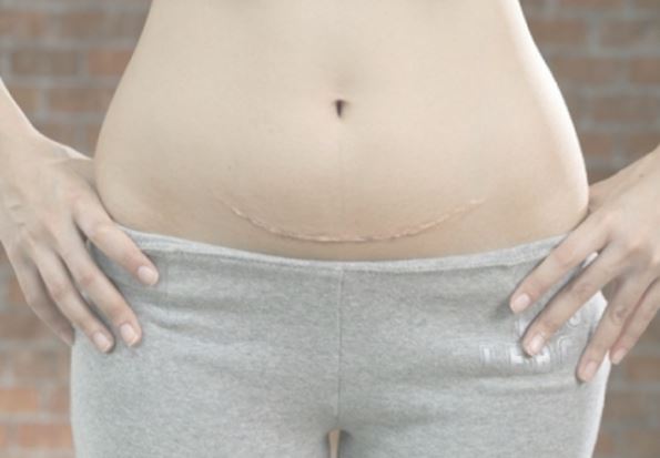 6 điều mẹ trẻ phải biết sau khi sinh mổ