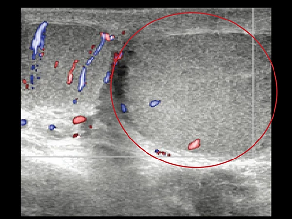 , siêu âm Doppler cho kết quả không có tín hiệu mạch máu ở tinh hoàn trái của bệnh nhân T, nếu không ử lý kịp thời tinh hoàn sẽ bị hoại tử, buộc phải cắt bỏ.