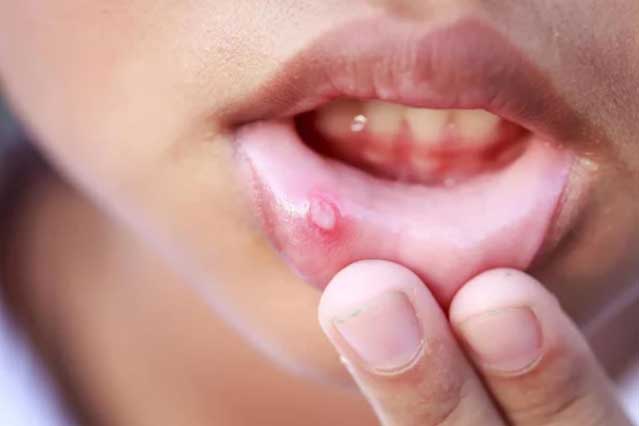 4 dấu hiệu trên miệng cảnh báo gan bị tổn thương nghiêm trọng, số 3 ai cũng bị nên dễ chủ quan