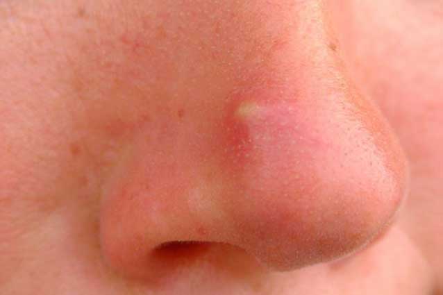 Nổi mụn ở vị trí cực kỳ nguy hiểm này là gan thận có vấn đề nghiêm trọng, cần đi khám gấp