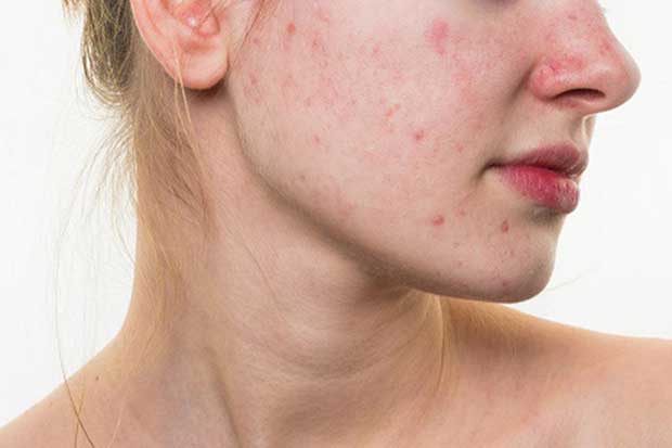 Cơ thể xuất hiện dấu hiệu này chứng tỏ gan đang bị nhiễm độc, cần đi khám trước khi quá muộn