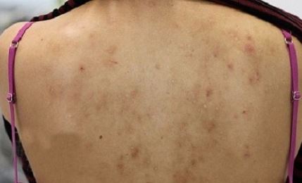 Chỉ cần dùng mẹo này sẽ không lo mụn trứng cá ở lưng