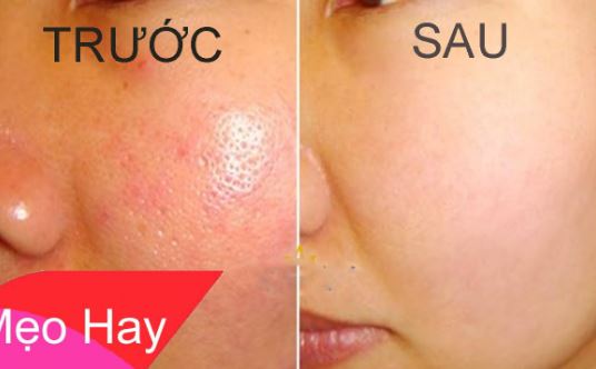 Se lỗ chân lông ngay lập tức bằng phương pháp đơn giản
