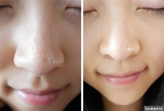 trị mụn 