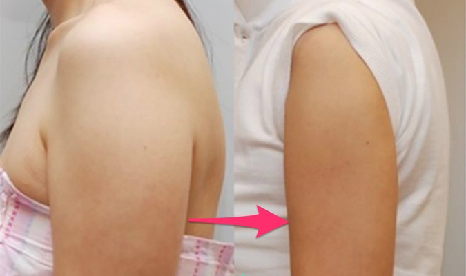 Cách giảm mỡ bắp tay cực dễ ai cũng có thể thực hiện