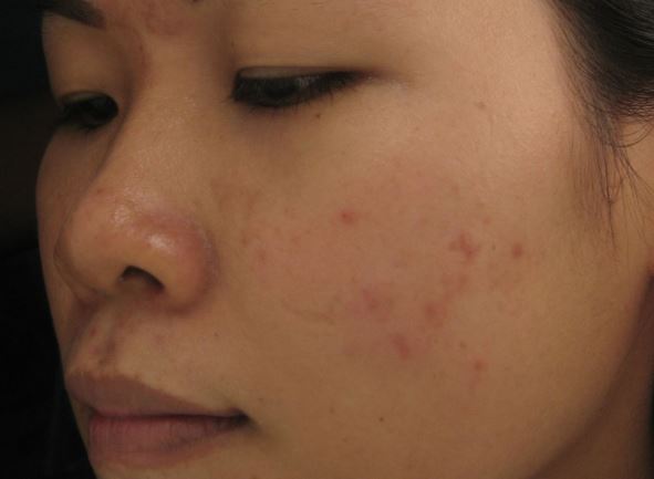 Thâm mụn nặng đến mấy cũng chữa được chỉ bằng cách dùng nghệ