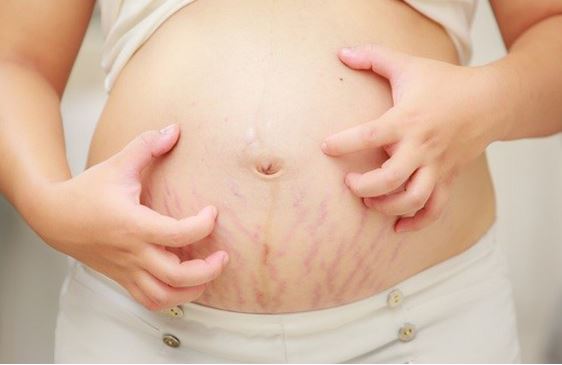 Cách chữa rạn da tại nhà an toàn và hiệu quả