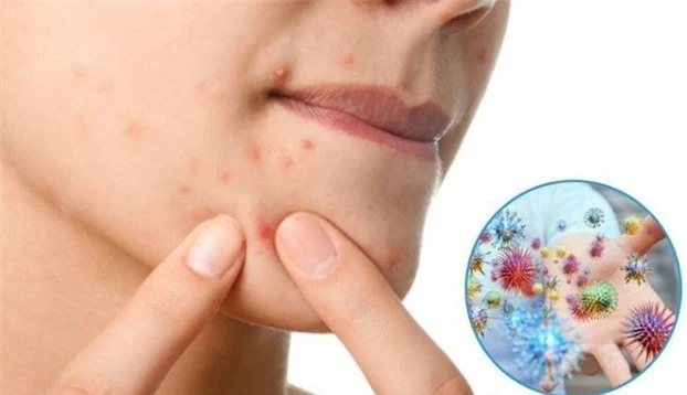 Nặn mụn dễ khiến vi khuẩn lây lan đến các vùng da khác, khiến mụn bùng phát nhiều hơn. Ảnh minh họa
