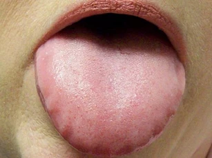 Lưỡi có biểu hiện này coi chừng bệnh đau dạ dày