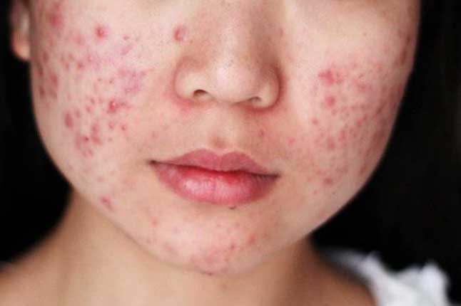 Thấy dấu hiệu "lạ" này trên mặt, hãy cảnh giác vì gan đang gửi lời báo động tới bạn