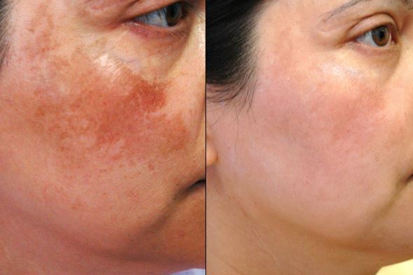 Nám da cực sạch chỉ bằng cách vô cùng đơn giản