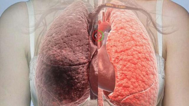 'Chỉ mặt' nguyên nhân gây ung thư phổi ngay hôm nay