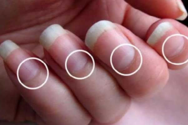 Móng tay xuất hiện dấu hiệu này báo hiệu sức khỏe đang gặp trở ngại, bạn nên đi kiểm tra sớm