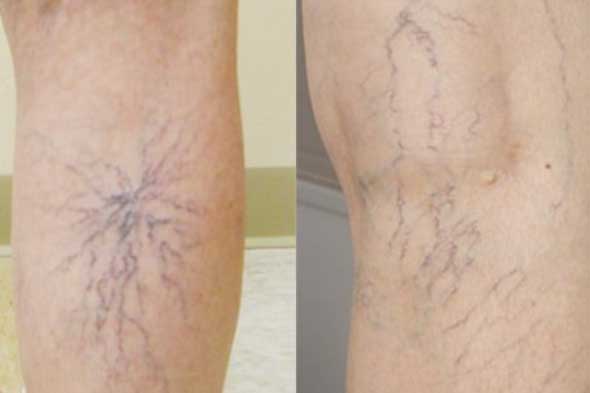 5 phương pháp giúp bạn phòng ngừa bệnh giãn tĩnh mạch, lưu thông khí huyết lên não, sống thọ