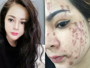 Cô gái trẻ cháy mặt vì nghe lời spa chấm nám