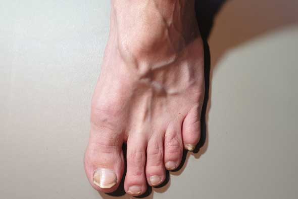 Chân lá gan thứ 2 của con người: 4 dấu hiệu ở chân cho thấy gan đang suy yếu, có 1/4 cũng đáng lo