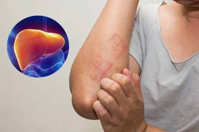 Cơ thể bị “ngứa ngáy” 2 chỗ này, 90% là biểu hiện của bệnh xơ gan: Bất ngờ khi biết thủ phạm