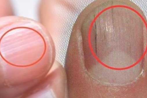 Móng tay có đường vân dọc ngầm cảnh báo 4 vấn đề sức khỏe nghiêm trọng, đừng coi thường