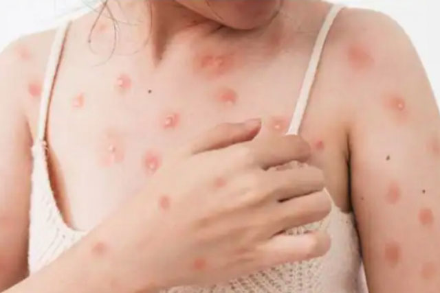 6 loại thực phẩm giúp phục hồi sau khi bị bệnh đậu mùa khỉ