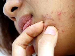 Thay đổi thói quen này bạn sẽ không phải lo mụn