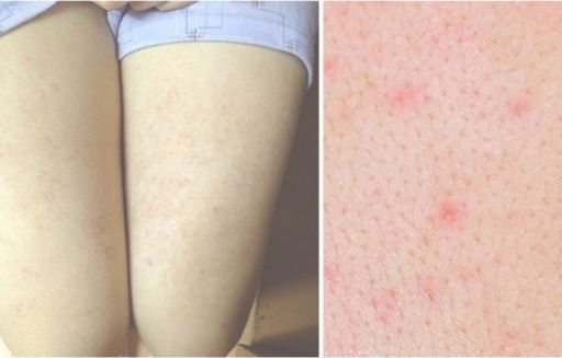 Chữa viêm lỗ chân lông chưa bao giờ đơn giản đến thế