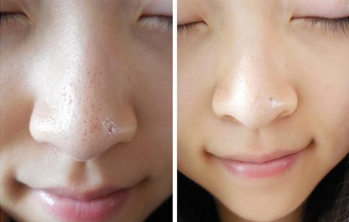 3 công thức trị mụn đầu đen tại nhà đơn giản nhất