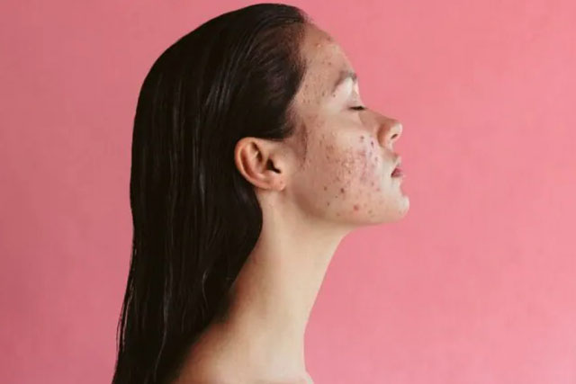 Ăn gì để hết mụn?