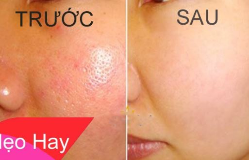 Lỗ chân lông to mấy cũng thu nhỏ chỉ bằng cách đơn giản
