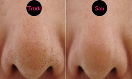 4 bước để mụn đầu đen không bao giờ tìm đến bạn