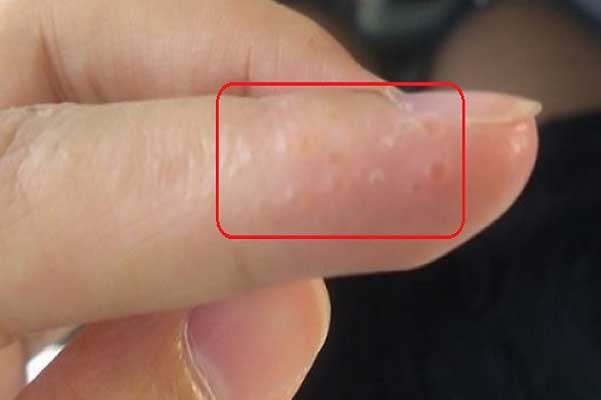 Khi bạn nhìn thấy biểu hiện này ở ngón tay hãy đi khám gấp kẻo hối hận thì đã quá muộn