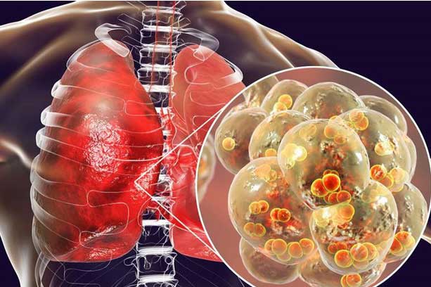 4 dấu hiệu cảnh báo căn bệnh ung thư phổi đang tấn công cơ thể, đừng coi thường kẻo mất mạng