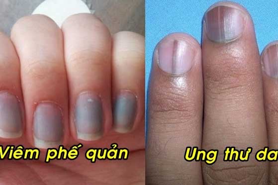 Móng tay có dấu hiệu này cảnh báo căn bệnh nguy hiểm đang đứng ngay cạnh bạn, cần gặp bác sĩ ngay
