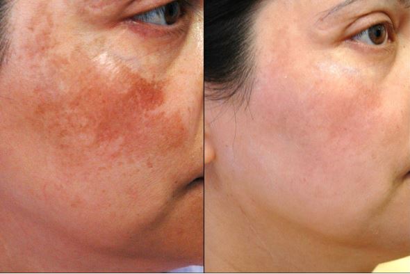 4 điều cần ghi nhớ để trị sạch nám da