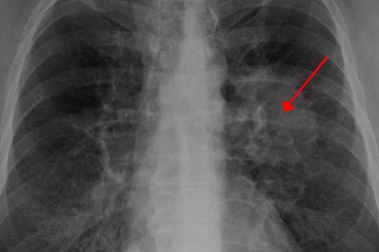 8 dấu hiệu cảnh báo ung thư phổi đang sống trong cơ thể, ai cũng biết sớm kẻo hối hận