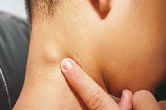 Cơ thể có 3 tín hiệu lạ ở cổ chứng tỏ K gõ cửa, nhiều người biết mà làm ngơ