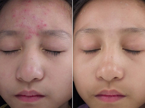 4 loại rau quen thuốc giúp bạn không phải lo về mụn trứng cá