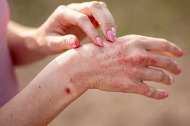 5 lầm tưởng về bệnh viêm da dị ứng