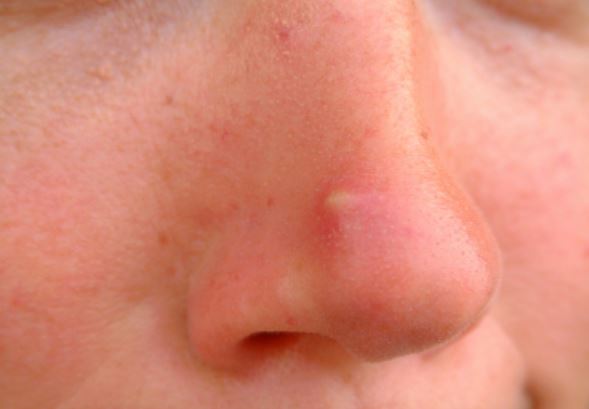 Vị trí mụn mọc trên mặt cảnh báo nhiều bệnh