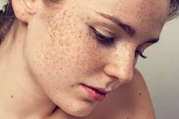 Đây là những nguyên nhân gây ra tàn nhang, nám da ở phụ nữ và cách phòng ngừa