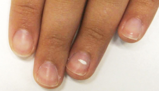 Sự thật về đốm trắng trên móng tay bạn phải biết?
