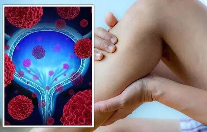 Gặp những biểu hiện này khi đi tiểu, coi chừng bệnh ung thư bàng quang đang "tìm đến" bạn