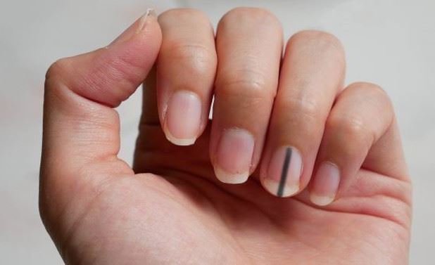 Móng tay có thể báo động tình trạng sức khỏe, thấy những biểu hiện lạ thường này cần gặp bác sĩ ngay