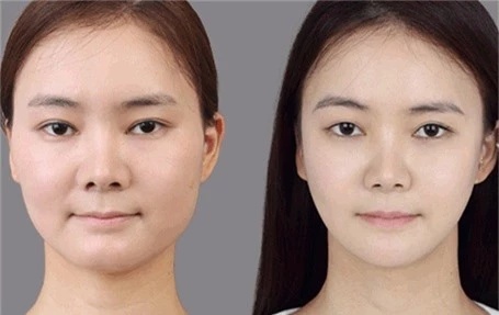 giảm béo mặt